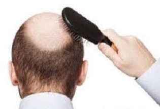 توصیه‌هایی برای جلوگیری از ریزش مو